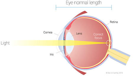 normal vision - Anaheim Eye Institute