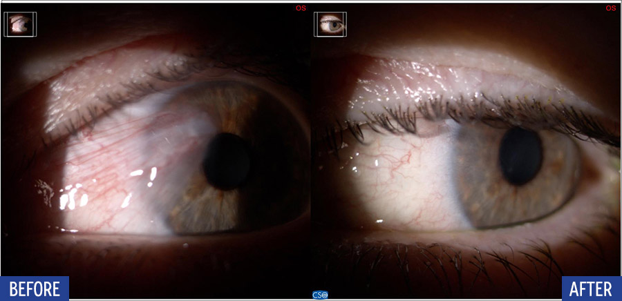 Pterygium