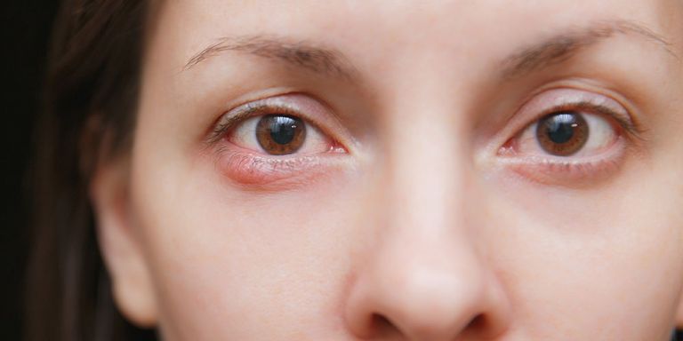 Chalazion sympthoms