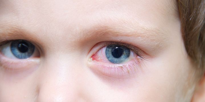 Pink Eye: Causes, Symptoms, Risks, and Treatment - Anaheim Eye Institute