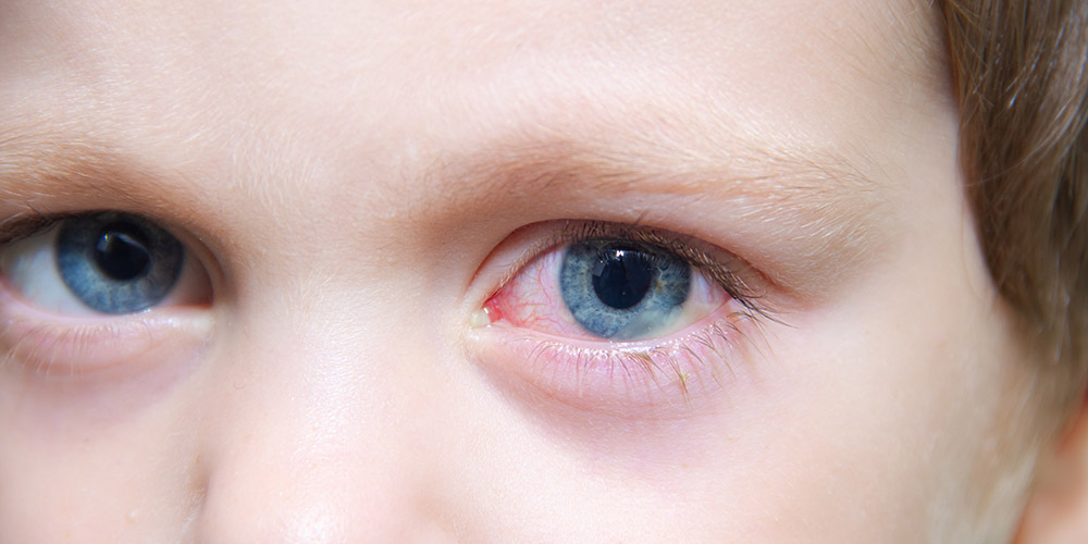 How Do Toddlers Get Pink Eye?