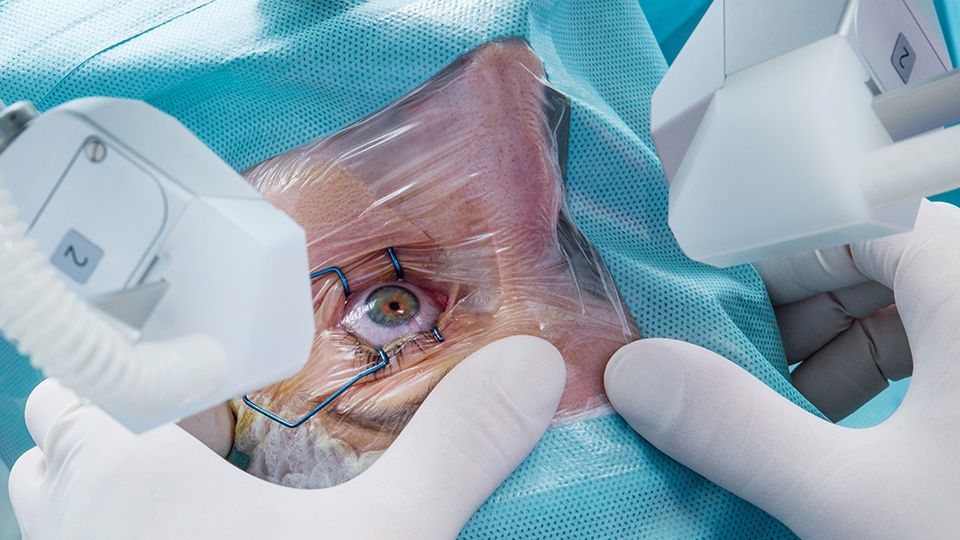 anaheim-eye-rle-surgery