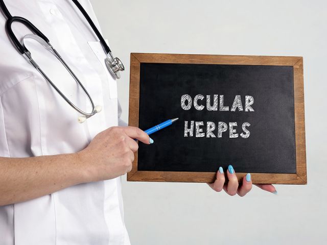 anaheim-eye-Ocular-Herpes