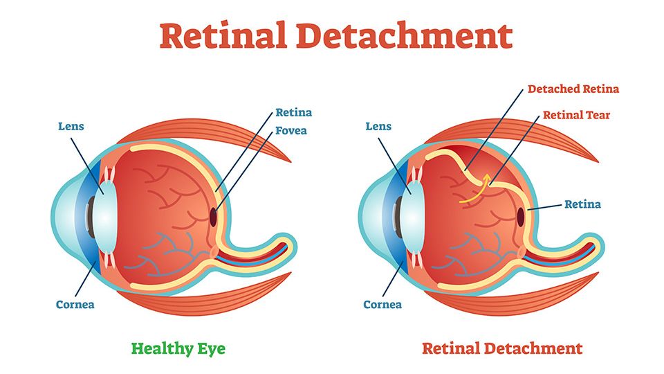 anaheim-eye-Retinal_Detachment
