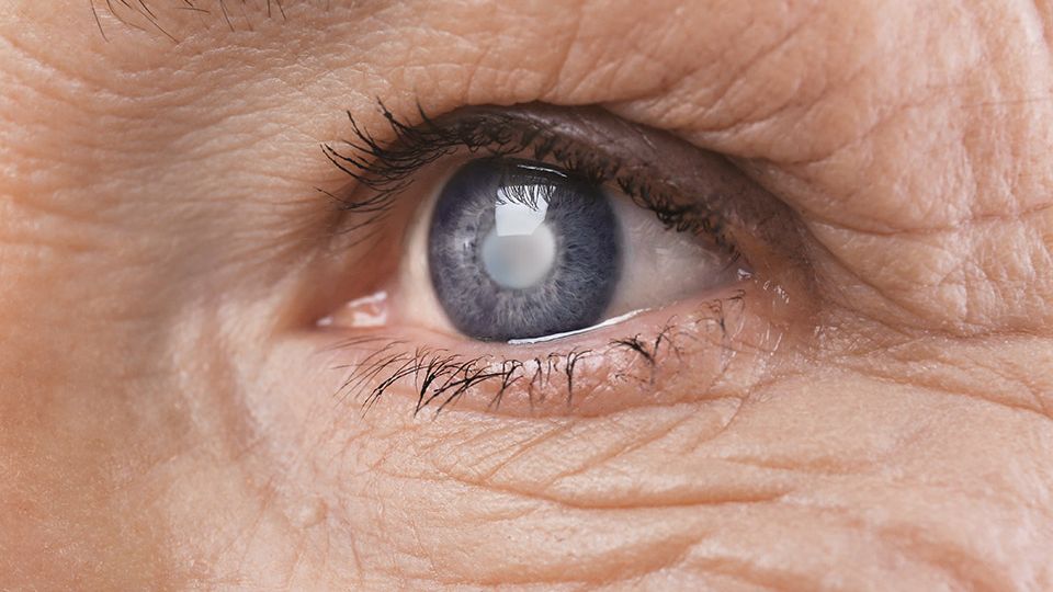Types of Cataracts