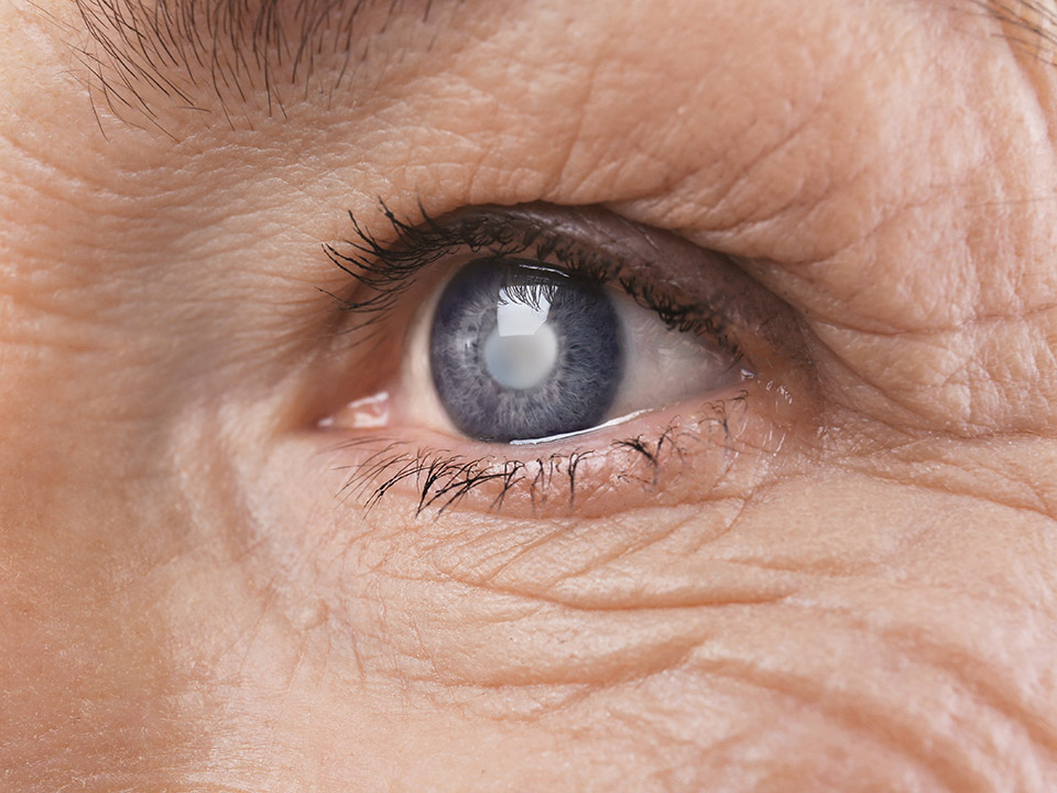 The Three Types Of Cataracts And Their Treatments