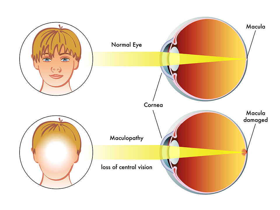 The Importance of Eye Exams in Detecting Macular Degeneration