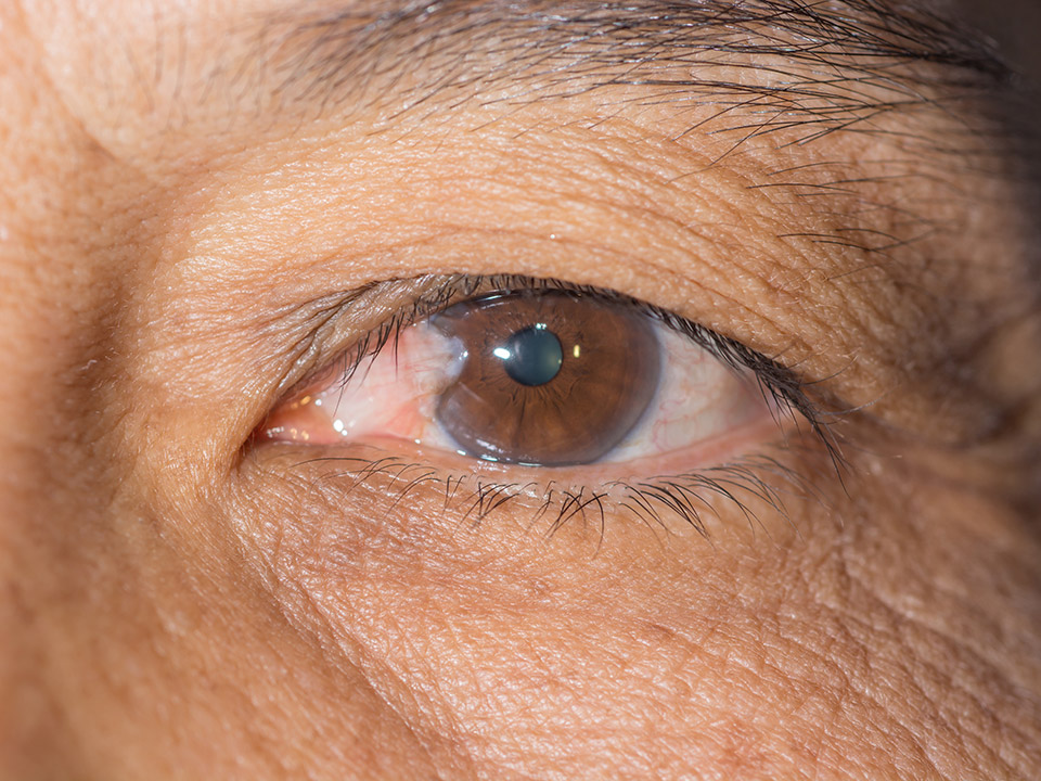 How To Treat Pterygium Without Surgery