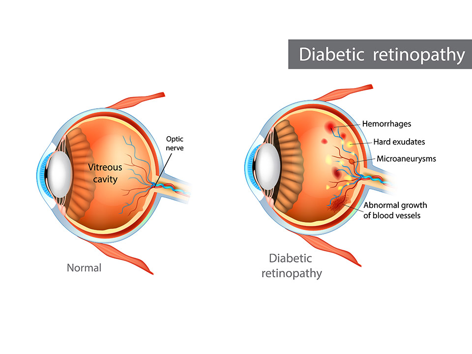 Diabetic Retinopathy