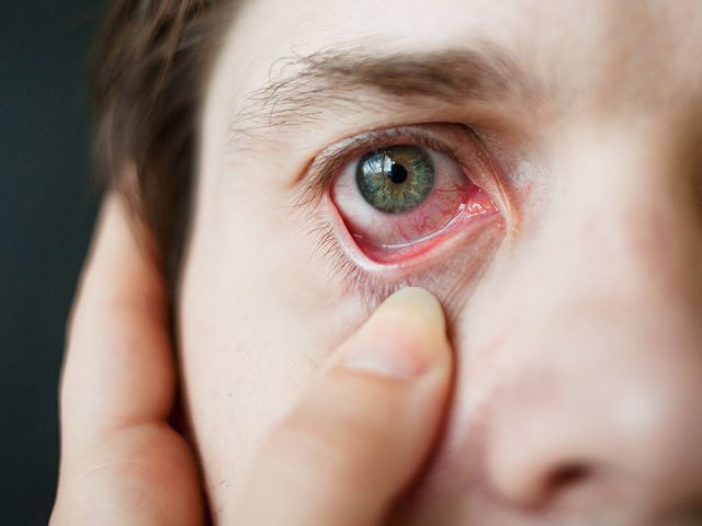 anaheim-eye-eye-allergy