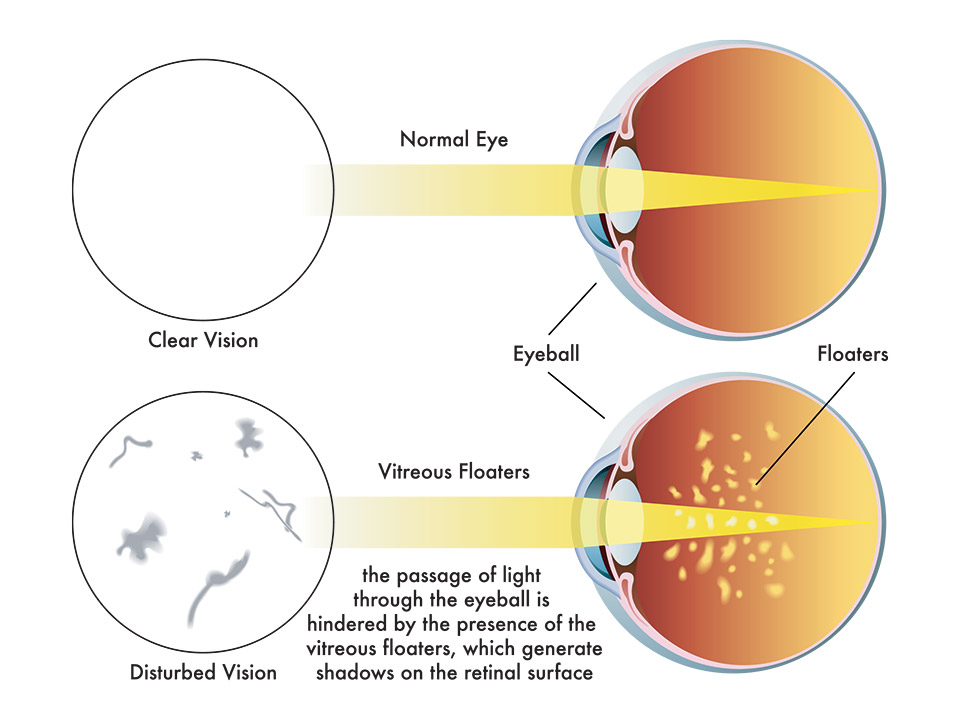What Causes Wavy Lines In Your Peripheral Vision In India Infoupdate