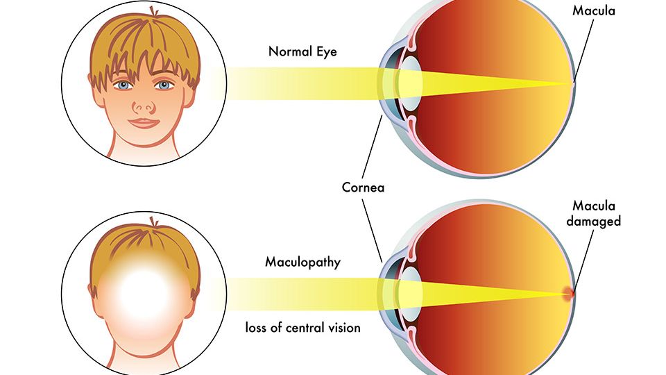 Macular Degeneration