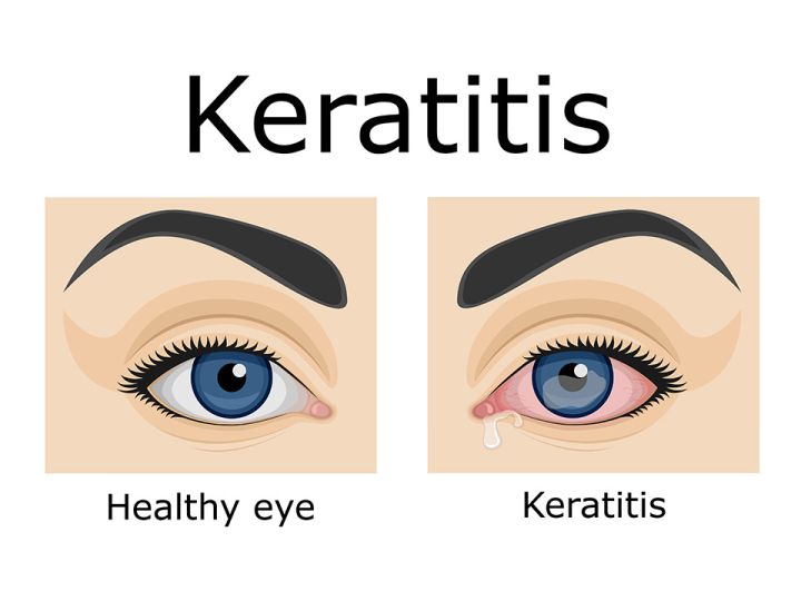 Bacterial Keratitis: Causes, Symptoms, And Treatment - Anaheim Eye ...