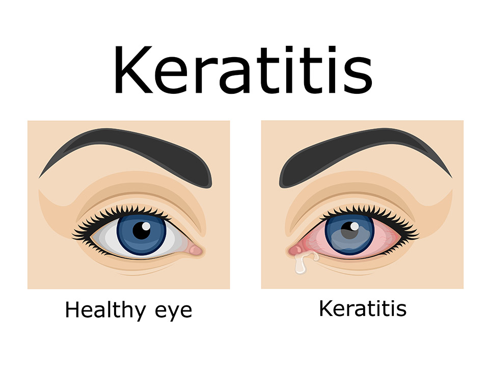 Bacterial Keratitis