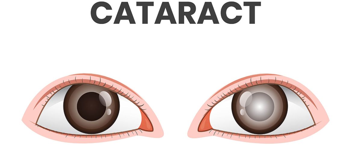 cataract surgery eye example