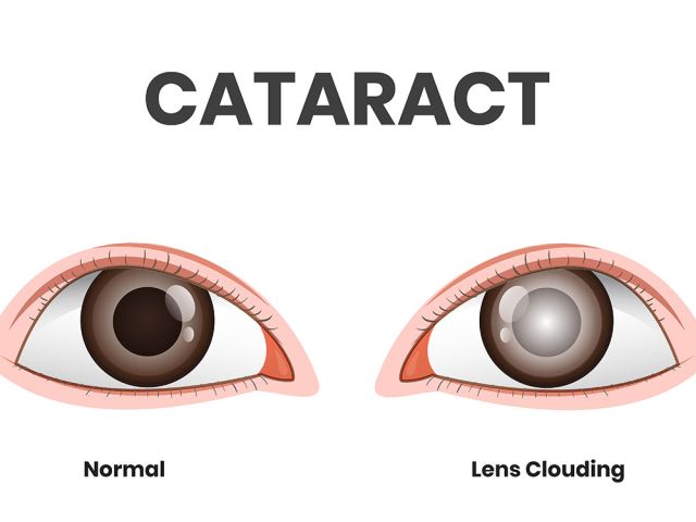 cataract surgery eye example