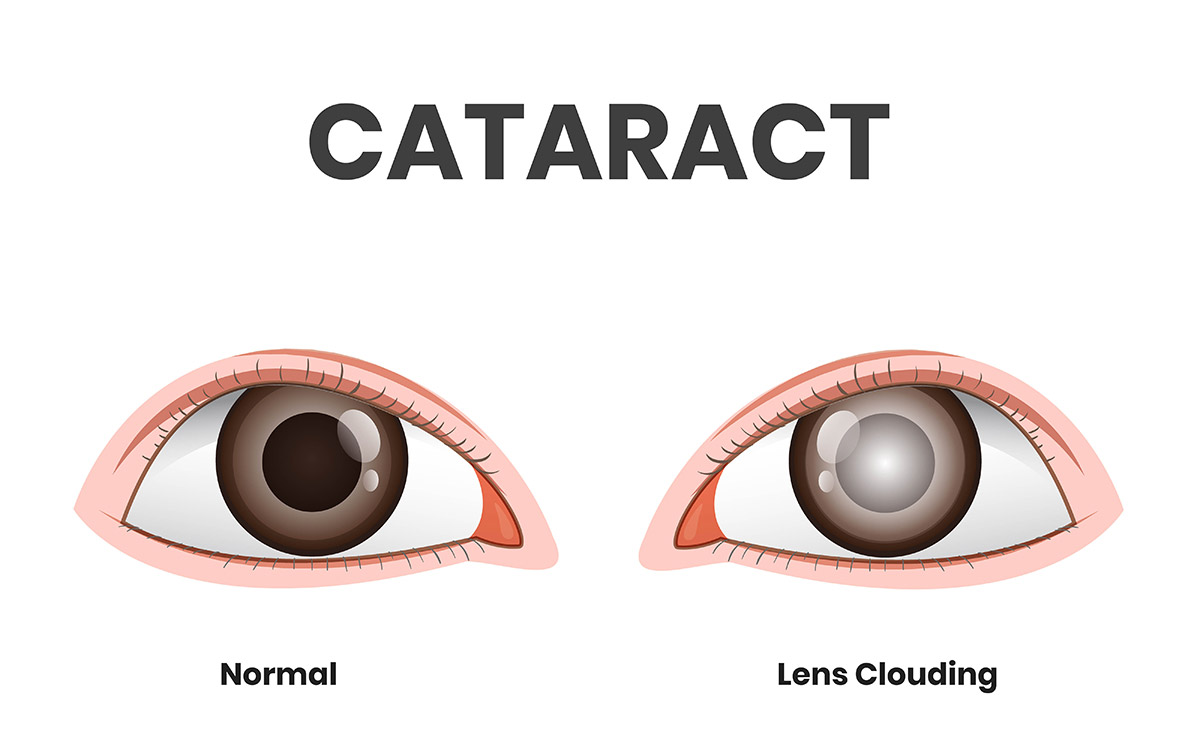 cataract surgery eye example