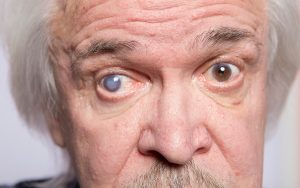 man with cataracts