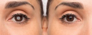 patient with and without cataracts