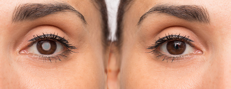 patient with and without cataracts