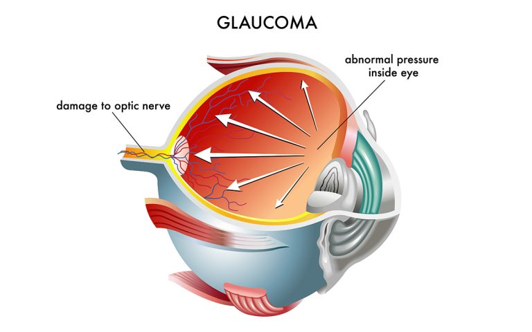 Glaucoma