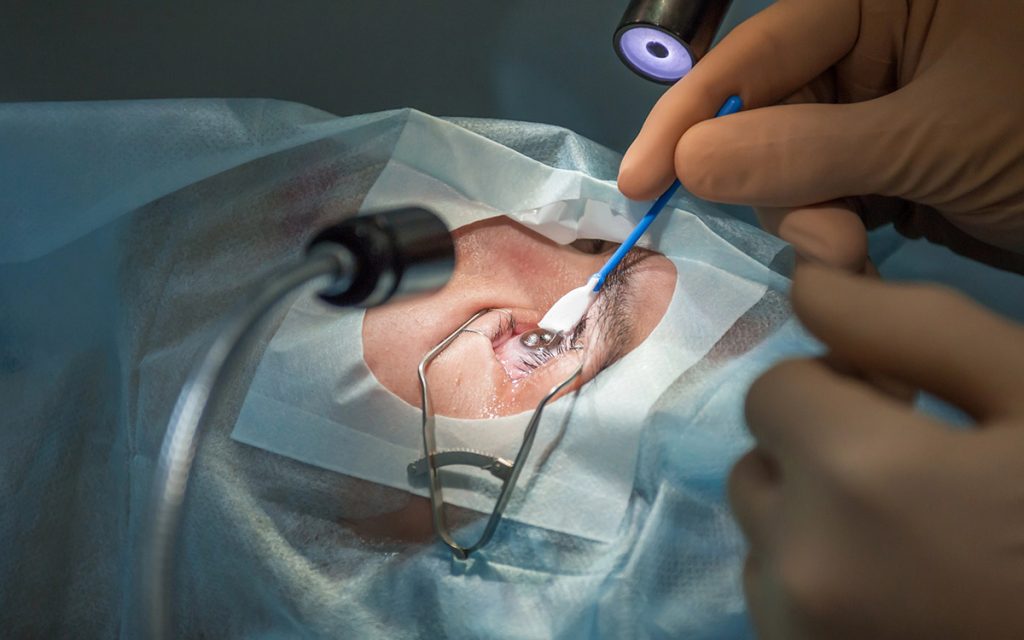doctor preparing for LASIK surgery