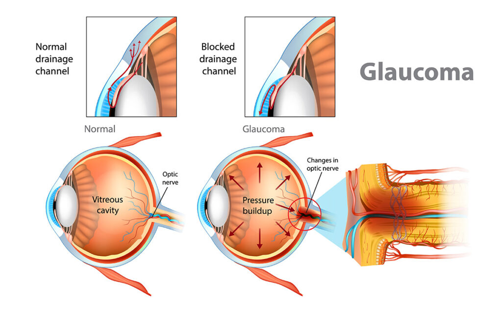 Illustration showing open-angle glaucoma