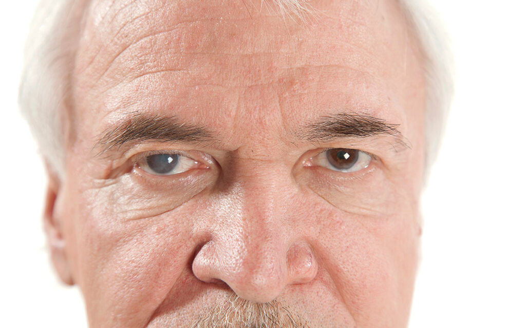 senior man with eye disease