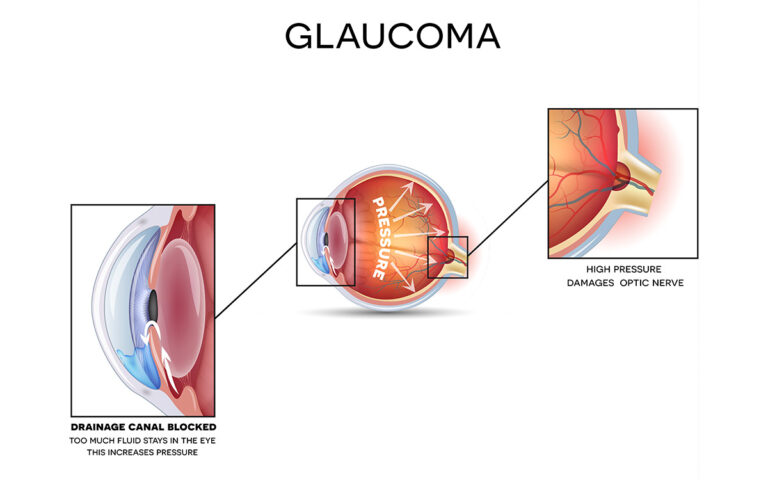 glaucoma illustration